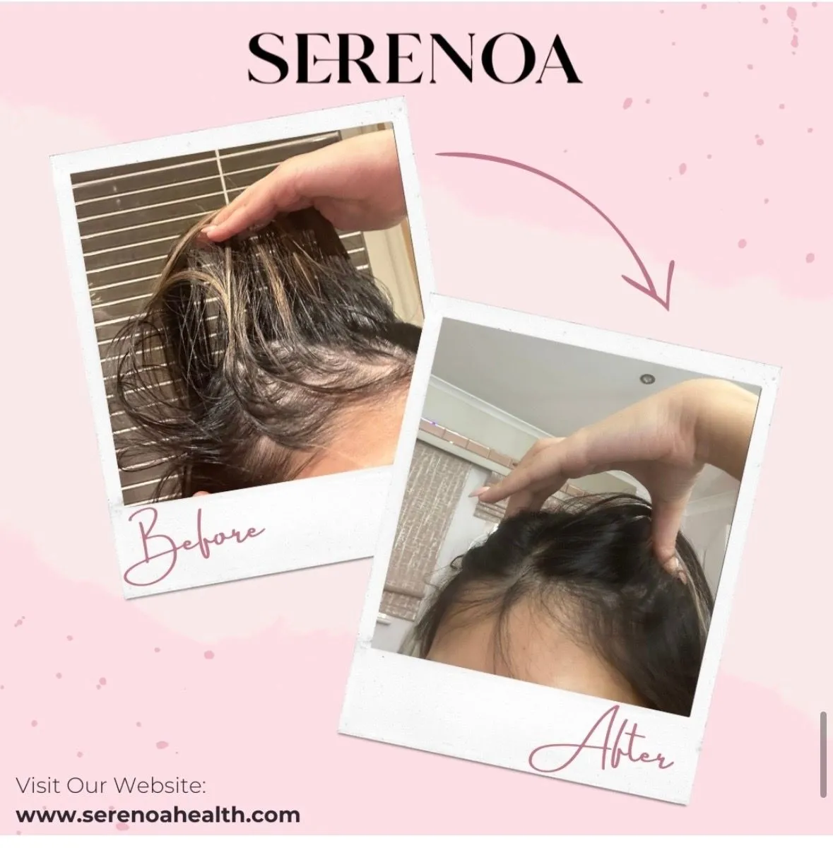 Customer-submitted before and after photos showing an individual hairline progress journey